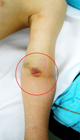 図2．上腕骨顆上骨折例の皮下血腫