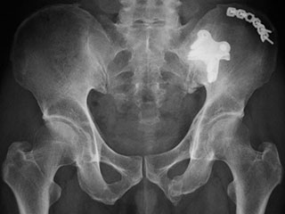 骨盤骨折 一般社団法人 日本骨折治療学会 骨折の解説