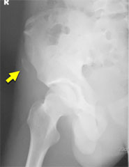 図6　上前腸骨棘剥離骨折(11歳、男児)