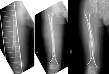 図4：11歳　男児　交通事故　髄内釘(Ender釘)固定症例(受傷時、術後、術後4か月)