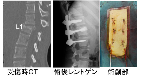 図2：第1腰椎脱臼骨折