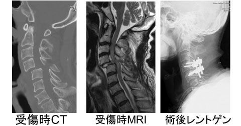 図4：第4頸椎脱臼骨折