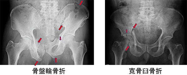 図1.骨盤輪骨折と寛骨臼骨折