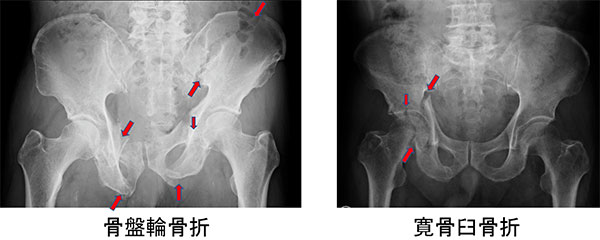 高齢者の骨盤骨折 一般社団法人 日本骨折治療学会 骨折の解説