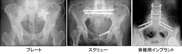 図2.骨盤輪骨折の手術治療