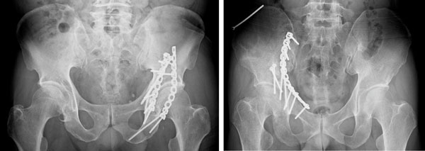 図3.寛骨臼骨折の手術治療