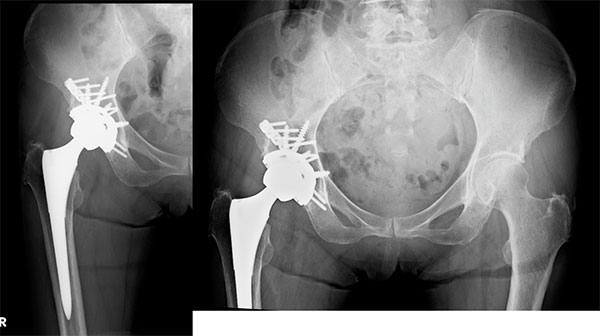 図4.寛骨臼骨折の骨接合と人工関節を組み合わせた手術治療