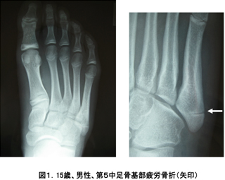 図1.15歳、男性、第5中足骨基部疲労骨折