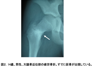 骨折 と は 疲労 疲労骨折とは？原因や予防方法について解説