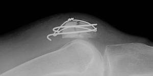 膝蓋骨骨折 一般社団法人 日本骨折治療学会 骨折の解説