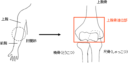 成人の上腕骨遠位部骨折 一般社団法人 日本骨折治療学会 骨折の解説