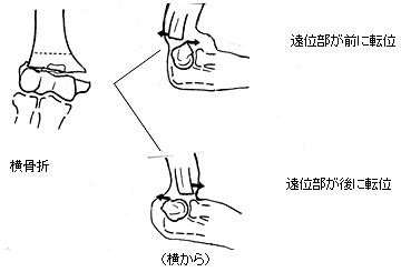 成人の上腕骨遠位部骨折 一般社団法人 日本骨折治療学会 骨折の解説