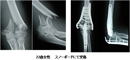 成人の上腕骨遠位部骨折 一般社団法人 日本骨折治療学会 骨折の解説
