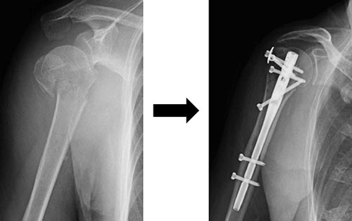 図3 髄内釘固定法
