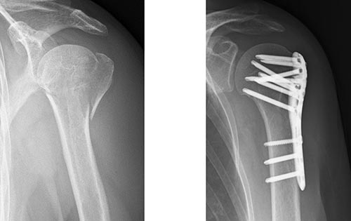 図4 ロッキングプレート固定法