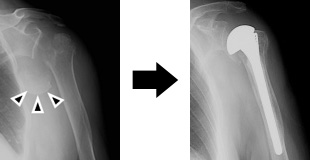 図5　人工骨頭置換術（▲が骨頭骨片）