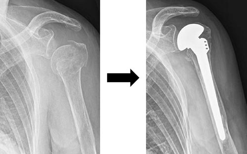 図5 肩人工骨頭置換術
