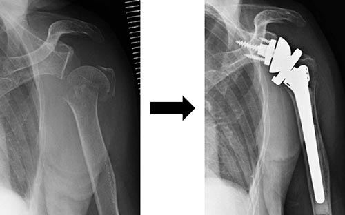図6 リバース型人工肩関節置換術