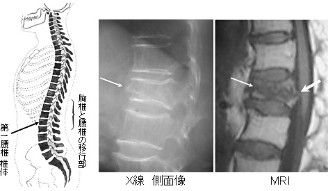 骨粗鬆症による脊椎圧迫骨折 一般社団法人 日本骨折治療学会 骨折の解説